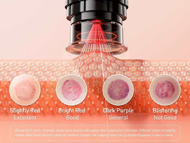 Smart Cupping Therapy Set with 8 Massage Cups