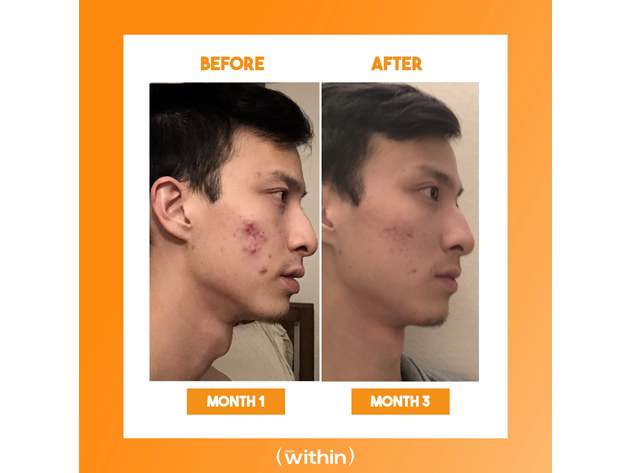 Clear Within Daily Skincare Supplement