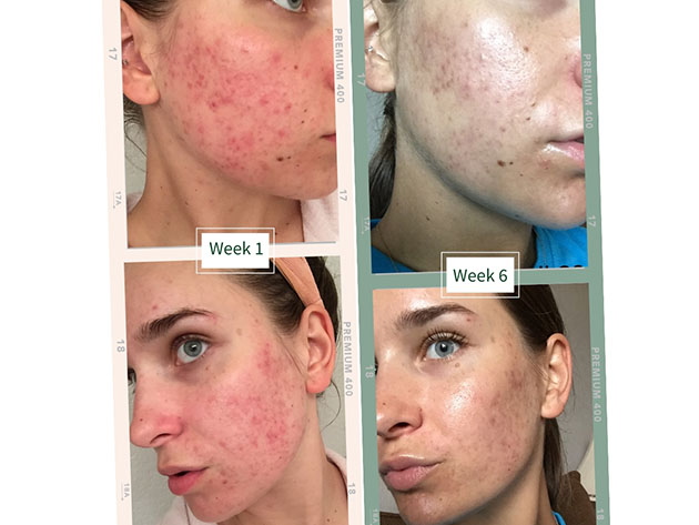 Phyla Probiotic Acne Skincare System