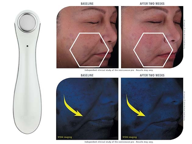 Soniceraser Pro 3-in-1 Infusion Device